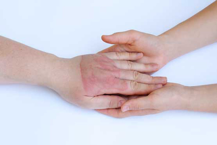 مراقبت از زخم سوختگی در خانه - نحوه‌ی مراقبت از زخم‌های سوختگی و درمان آنها با اطلاعات کامل و راهنمایی مفید.