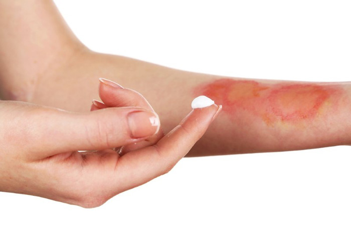 مراقبت از زخم سوختگی در خانه - نحوه‌ی مراقبت از زخم‌های سوختگی و درمان آنها با اطلاعات کامل و راهنمایی مفید.