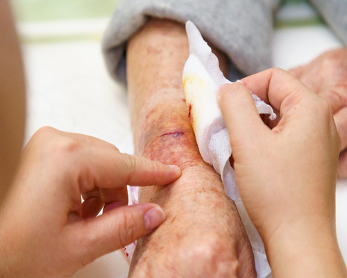 مطالب مفید در مورد زخم و عفونت پوستی کلینیک پاشنه
