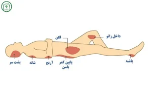 زخم بستر درمان و پیشگیری