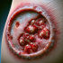 زخم‌های ناشی از عفونت‌های قارچی سطحی