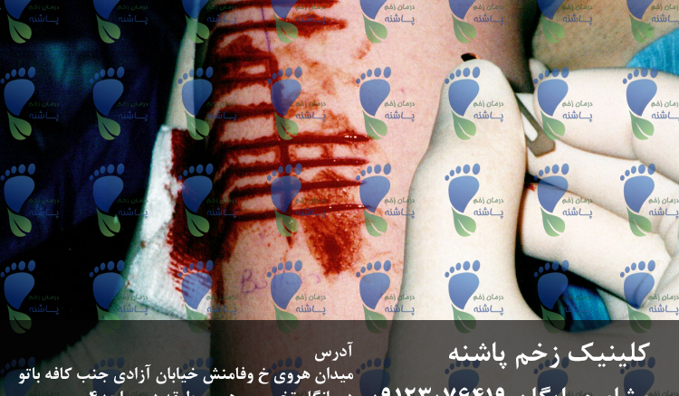 درمان تخصصی زخم پارگی در کلینیک زخم پاشنه