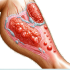 عفونت پوستی اریزیپلاس با قرمزی و التهاب شدید