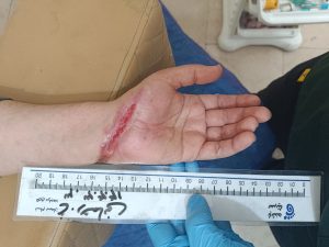 پزشک در حال معاینه زخم سوختگی روی پای بیمار در کلینیک زخم پاشنه
