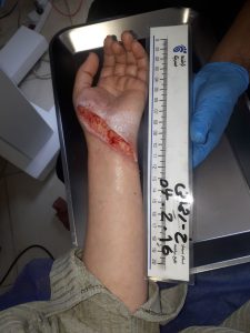 پزشک در حال معاینه زخم سوختگی روی پای بیمار در کلینیک زخم پاشنه