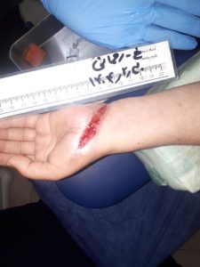 پزشک در حال معاینه زخم سوختگی روی پای بیمار در کلینیک زخم پاشنه