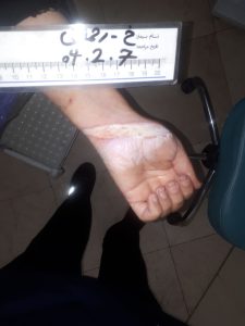 پزشک در حال معاینه زخم سوختگی روی پای بیمار در کلینیک زخم پاشنه