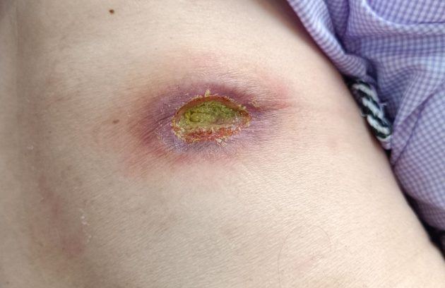 تصویری واقعی از درمان زخم درجه ۳ پا توسط متخصص در کلینیک زخم پاشنه