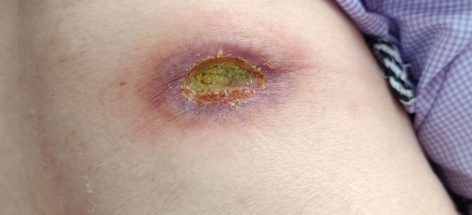 تصویری واقعی از درمان زخم درجه ۳ پا توسط متخصص در کلینیک زخم پاشنه