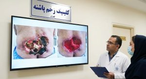 کاهش شدت مراحل و درجات زخم بستر عمیق (تبدیل گرید ۴ به ۳).