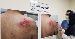 روند بهبود مراحل و درجات زخم بستر از گرید ۲ به گرید ۱ در ناحیه کتف.