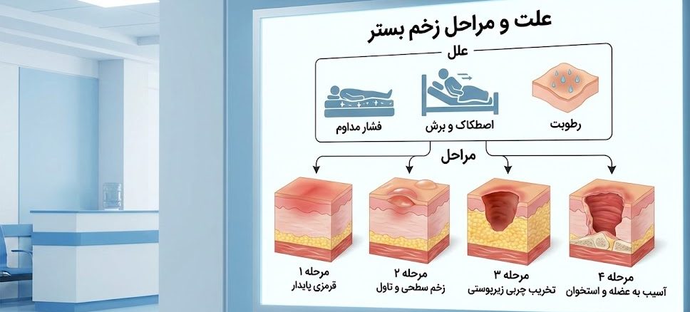 اینفوگرافیک پزشکی نشان‌دهنده فیزیولوژی، علت و مراحل زخم بستر از گرید ۱ تا ۴ روی لایه‌های مختلف پوست.