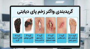 نمودار تصویری سیستم طبقه‌بندی واگنر که شش گرید مختلف از علائم و مراحل زخم پای دیابتی را از مرحله صفر (بدون زخم) تا مرحله پنج (گانگرن کامل) نشان می‌دهد.