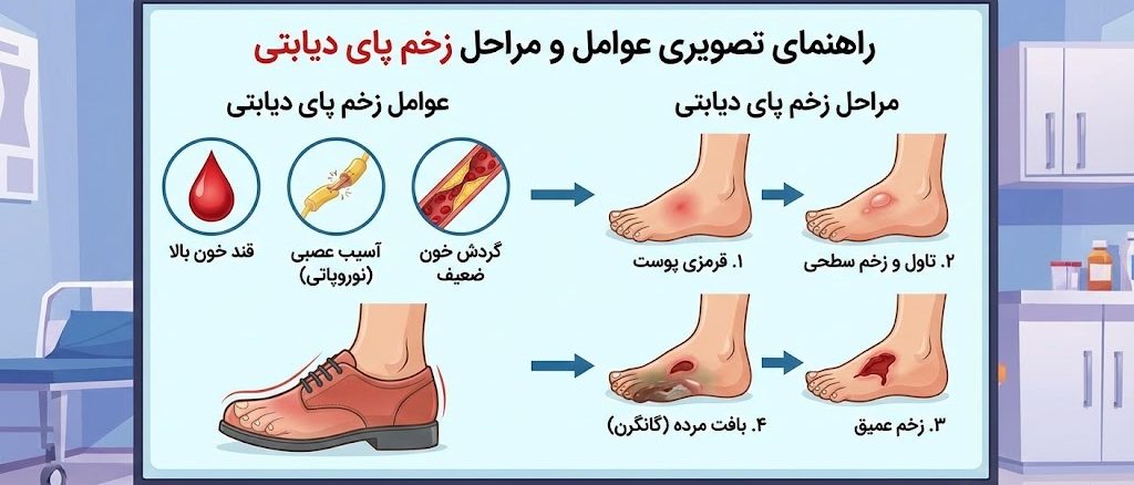 اینفوگرافیک پزشکی روی صفحه نمایش که ارتباط بین عوامل ایجادکننده (مانند قند بالا و نوروپاتی) و پیشرفت علائم و مراحل زخم پای دیابتی از قرمزی تا گانگرن را نشان می‌دهد.