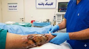 یک متخصص پزشکی با دستکش در حال انجام مراحل درمان زخم سوختگی درجه ۳ بر روی ساعد بیمار در محیط بالینی کلینیک پاشنه است.
