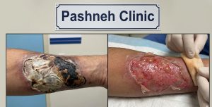مقایسه تصویری روند درمان زخم سوختگی درجه ۳ در کلینیک پاشنه؛ تصویر سمت چپ سوختگی عمیق و نکروزه اولیه را نشان می‌دهد و تصویر سمت راست، همان زخم را در مرحله بهبودی با بستر قرمز و دانه‌دار پس از اقدامات درمانی تخصصی به تصویر می‌کشد.