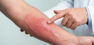 تشخیص اینکه زخم سوختگی درجه ۱ چیست و بررسی قرمزی سطحی پوست.