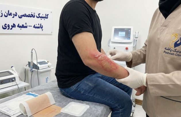 متخصص کلینیک پاشنه در حال معاینه و درمان تخصصی زخم سوختگی روی دست بیمار در شعبه هروی.