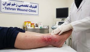 بررسی تخصصی یک زخم عروقی حاد، متورم و قرمز رنگ توسط کارشناس زخم جهت درمان فوری در تهران.