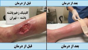 تصویر مقایسه‌ای شگفت‌انگیز از پای بیمار قبل و بعد از تکمیل دوره درمان زخم عروقی در تهران کلینیک پاشنه.