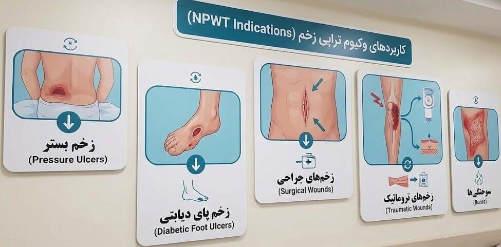 نمایش اینفوگرافیک و تابلوهای آموزشی کاربردهای وکیوم تراپی زخم برای انواع ضایعات مانند زخم بستر و پای دیابتی