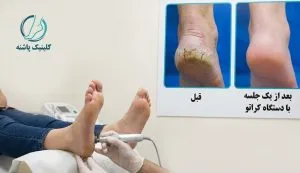 تصویر مقایسهای قبل و بعد از درمان کالوس و پینه ترکخورده پاشنه پا با استفاده از دستگاه کراتو در یک جلسه.