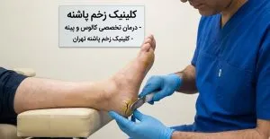 برای این تصویر، یک ساختار کامل سئو شامل Alt Text، Title، Caption و Description به فارسی بنویس. متخصص در حال انجام دبریدمان دستی برای درمان کالوس و پینه پاشنه پا در کلینیک زخم پاشنه تهران.