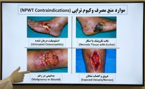 اسلاید آموزشی پزشکی روی مانیتور نشاندهنده موارد ممنوعه استفاده از وکیوم تراپی زخم (مشاوره در تهران).