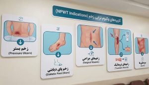 اینفوگرافیک دیواری در کلینیک که انواع زخمهای قابل درمان با وکیوم تراپی زخم در تهران را نشان میدهد.
