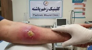 پزشک متخصص در حال معاینه یک آبسه پوستی بزرگ و ملتهب با مرکز زرد رنگ روی ساعد بیمار در کلینیک زخم پاشنه جهت درمان آبسه پوستی در تهران است