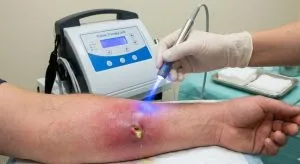 پزشک متخصص با استفاده از دستگاه اوزون تراپی در حال درمان یک آبسه پوستی بزرگ و عفونی روی ساعد بیمار در تهران است