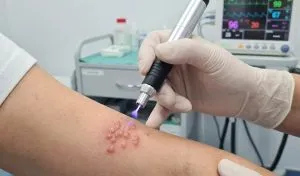 درمان کلینیکی تاول‌های فعال هرپس روی دست بیمار با استفاده از دستگاه پلاسمای سرد (Cold Plasma) توسط متخصص. درمان تاول تبخال (هرپس)