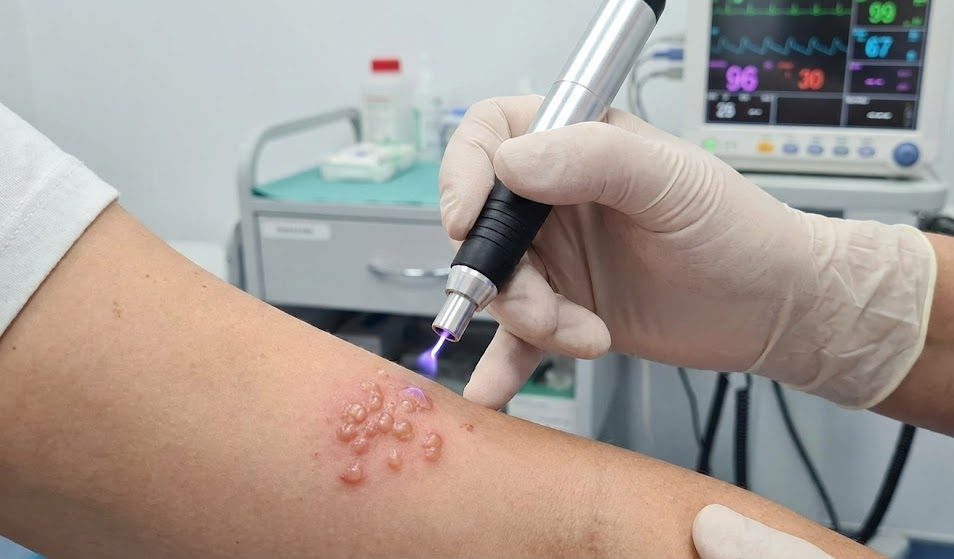 درمان کلینیکی تاول‌های فعال هرپس روی دست بیمار با استفاده از دستگاه پلاسمای سرد (Cold Plasma) توسط متخصص. درمان تاول تبخال (هرپس)
