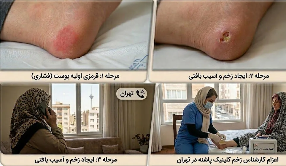 تصویر ترکیبی چهار پانل: نماهای نزدیک پزشکی از مرحله ۱ (قرمزی فشاری) و مرحله ۲ (زخم باز) ایجاد زخم بستر روی پاشنه پا، به همراه شخص در تهران که برای مشاوره تماس می‌گیرد و پرستاری که از کلینیک پاشنه برای درمان زخم بستر در تهران در منزل اعزام شده است.