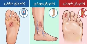 اینفوگرافیک مقایسه انواع زخم پا شامل زخم پای دیابتی، وریدی و شریانی برای تشخیص و درمان زخم پا.