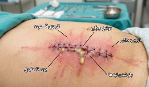 تصویر زخم عفونی شدید روی شکم با برچسب علائم خطر شامل قرمزی، ترشح چرکی و باز شدن بخیه‌ها که نیاز فوری به درمان عفونت‌های بعد از جراحی دارد.