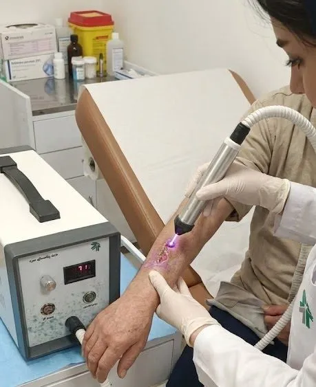 استفاده از دستگاه پلاسمای سرد برای درمان زخم سوختگی در تهران در کلینیک پاشنه