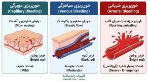 نمودار آموزشی انواع خونریزی شریانی، وریدی و مویرگی برای تشخیص علت خونریزی زخم